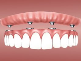 Vorteile von Zahnimplantaten